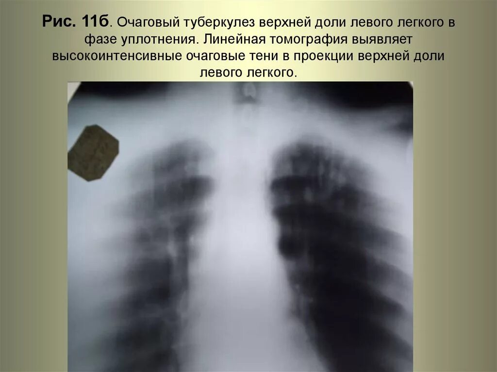 Очаг в верхней доле правого легкого. Линейная томограмма легких туберкулез. Очаговый туберкулез рентген. Очаговый туберкулез в фазе уплотнения. Очаговый туберкулёз верхних долей.