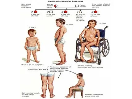 Дюшен болезнь