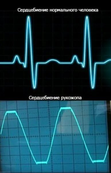 Пульс в нормальном состоянии. Нормальное биение сердца. нормальная частота биения сердца. нормальный пульс человека. нормальное сердцебиение у человека.