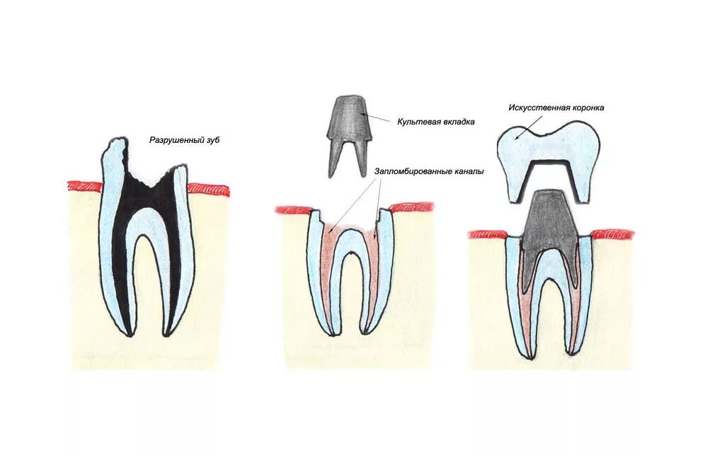Какую функцию выполняет коронка зуба. Штифто культевая вкладка. Культевая вкладка в стоматологии ортопедическая. Культевая вкладка и коронка.