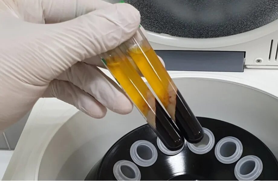 Процедура плазмолифтинга для суставов. PRP терапия Platelet Rich Plasma. Плазмотерапия сустав PRP. Плазмотерапия коленного сустава.