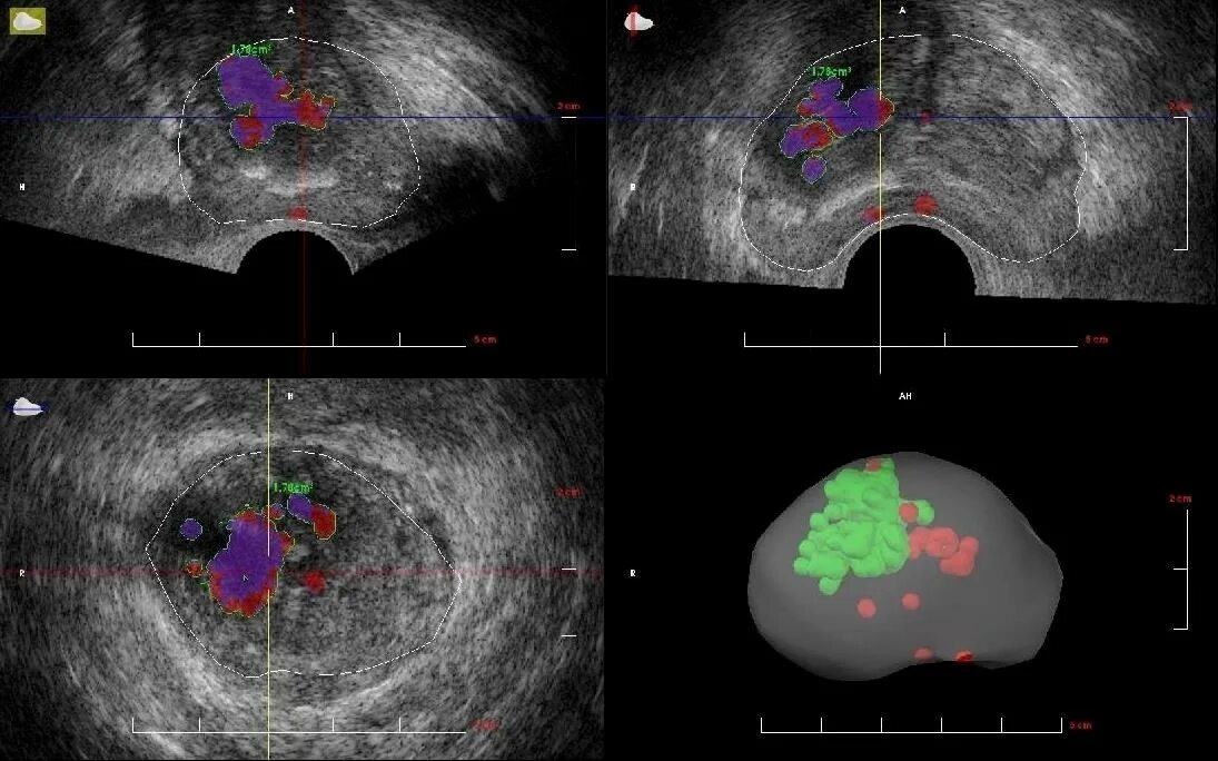 Предстательная железа рак лечится. Карцинома предстательной железы. Гистосканирование предстательной железы. Зональная анатомия предстательной железы УЗИ. Трансректальная биопсия предстательной железы под контролем УЗИ.