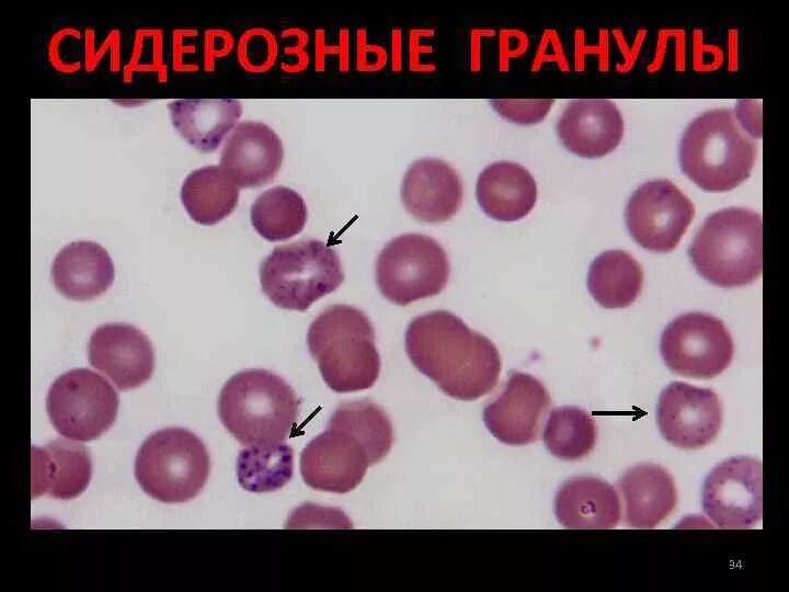 Тельце гейнца. Сидерозные гранулы в эритроцитах. Сидерозные (железосодержащие) гранулы эритроцитов. Тельца Паппенгеймера в эритроцитах. Сидерозные гранулы макрофаги.