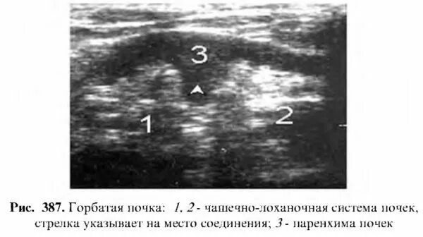 Галетообразная почка на УЗИ. Горбатая почка УЗИ описание. Деформация почки на УЗИ. Горбатая почка