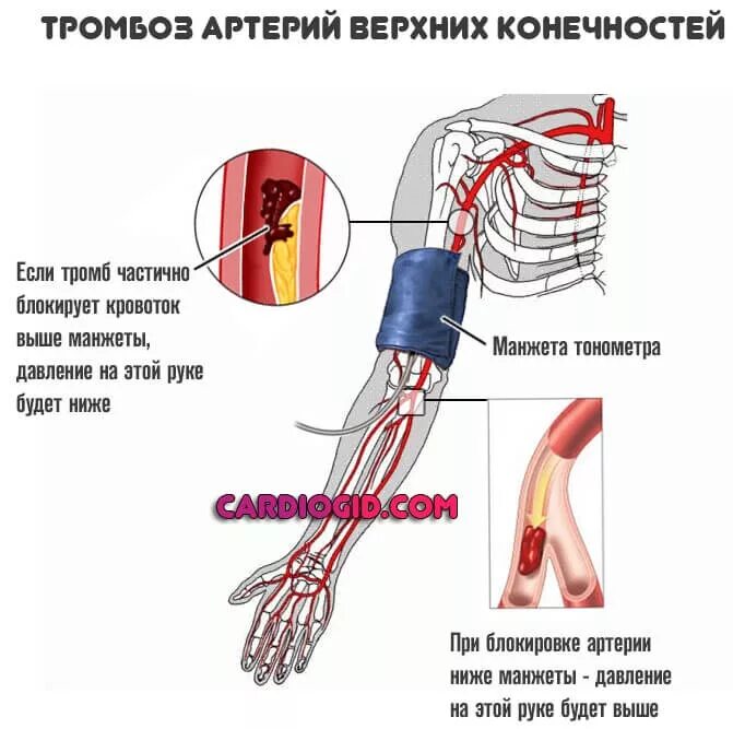 Тромбоз артерий верхних