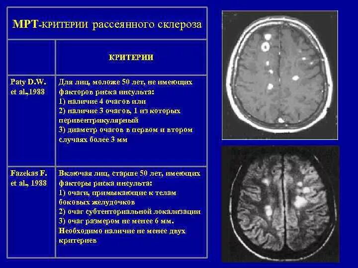 Склероз мозга. Мрт очаги поражения рассеянный склероз. Критерии очага на мрт при рассеянном склерозе. Очаги при рассеянном склерозе мрт. Очаги демиелинизации при рассеянном склерозе располагаются.