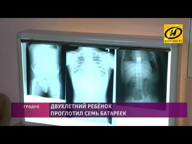 Ребенок проглотил батарейку. Ребёнок проглотил батарейку таблетку. проглатывание батареек детьми. что делать если проглотил батарейку. ребенок проглотил пальчиковую батарейку.