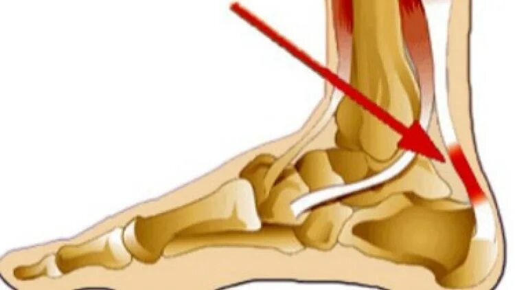 Слабость ахиллесова. Ахиллово сухожилие тендинит. Ахиллово сухожилие воспаление. Тендинита ахиллова сухожилия.