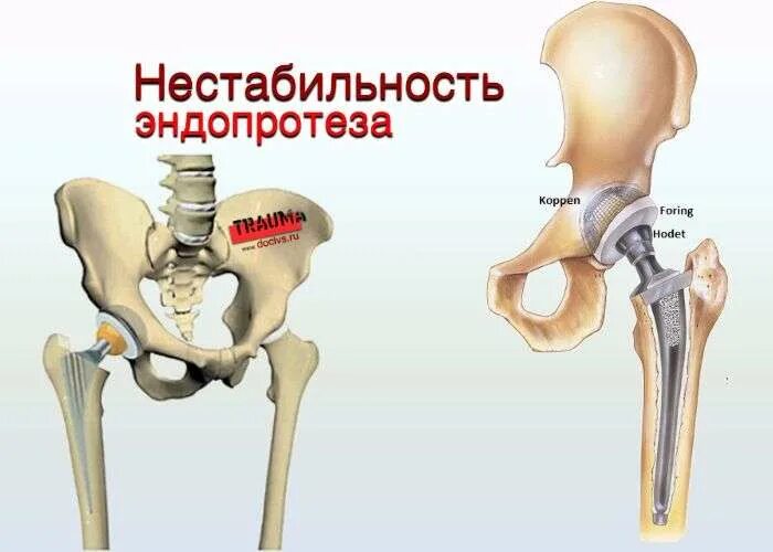 Можно ли после эндопротезирования тазобедренного сустава. Симптомы нестабильности эндопротеза тазобедренного сустава. эндопротез тазобедренного сустава кт. эндопротезирование тазобедренного сустава вывих кт. несостоятельность эндопротеза тазобедренного сустава.
