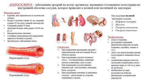Облитерирующий атеросклероз профилактика
