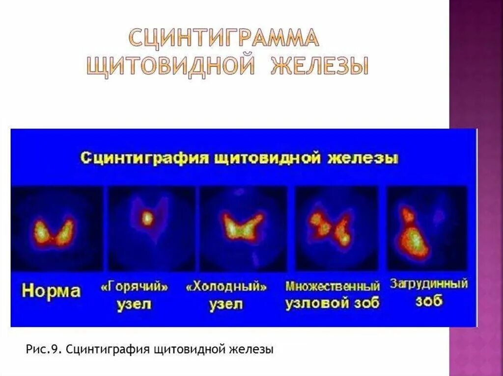 Радиоизотопный метод исследования щитовидной железы. Сцинтиграфия щитовидной железы холодный очаг. Холодный очаг при сцинтиграфии щитовидной железы. Щитовидная железа сцинтиграфия горячий очаг. Исследование зоба