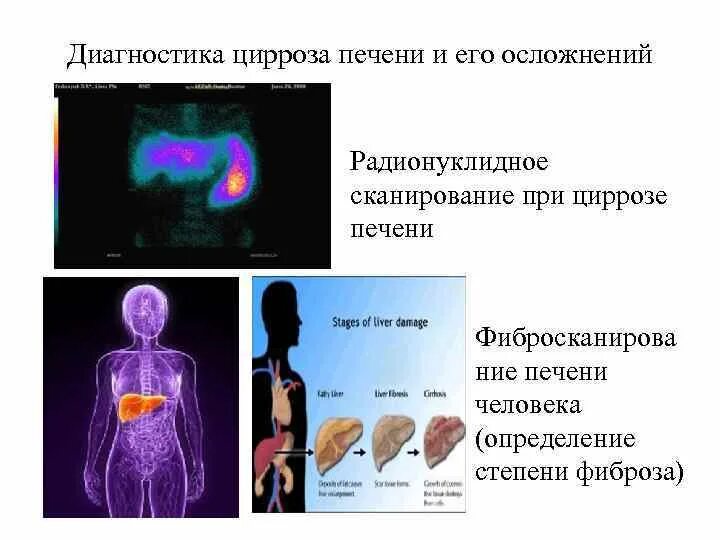 Диагнозы с печенью. Инструментальные исследования при циррозе печени. Диагностика при циррозе печени. Инструментальные методы исследования при циррозе печени. Инструментальные методы исследования цирроза.