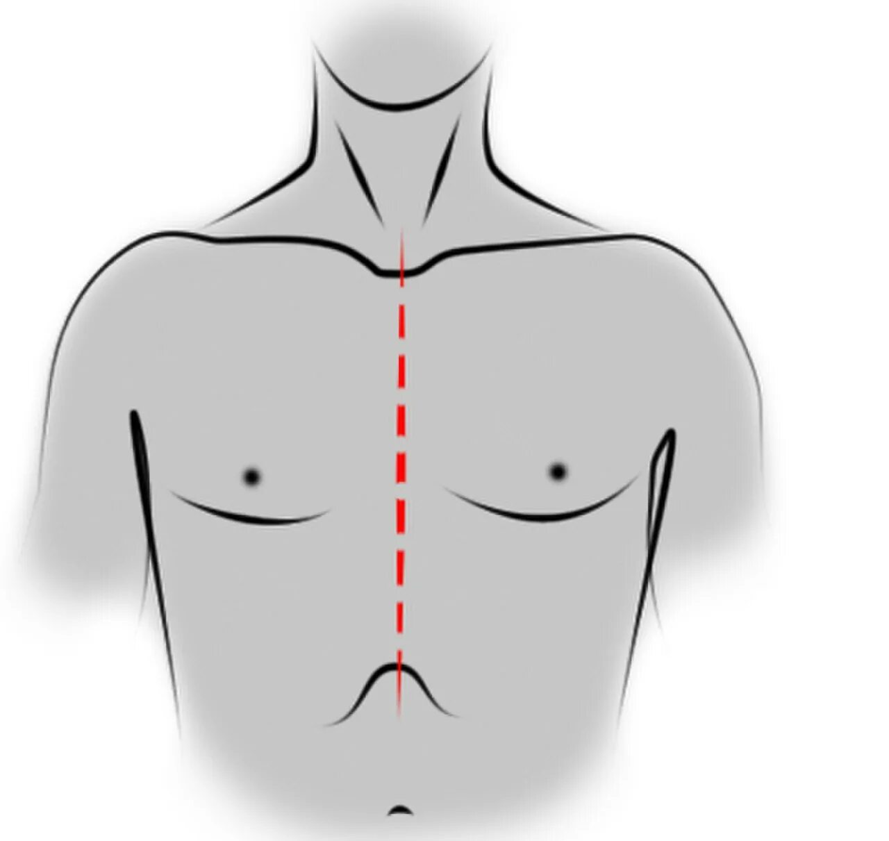 Срединная продольная стернотомия. Стернотомия грудной клетки что это. Срединная торакотомия. Рассечение грудины операция.