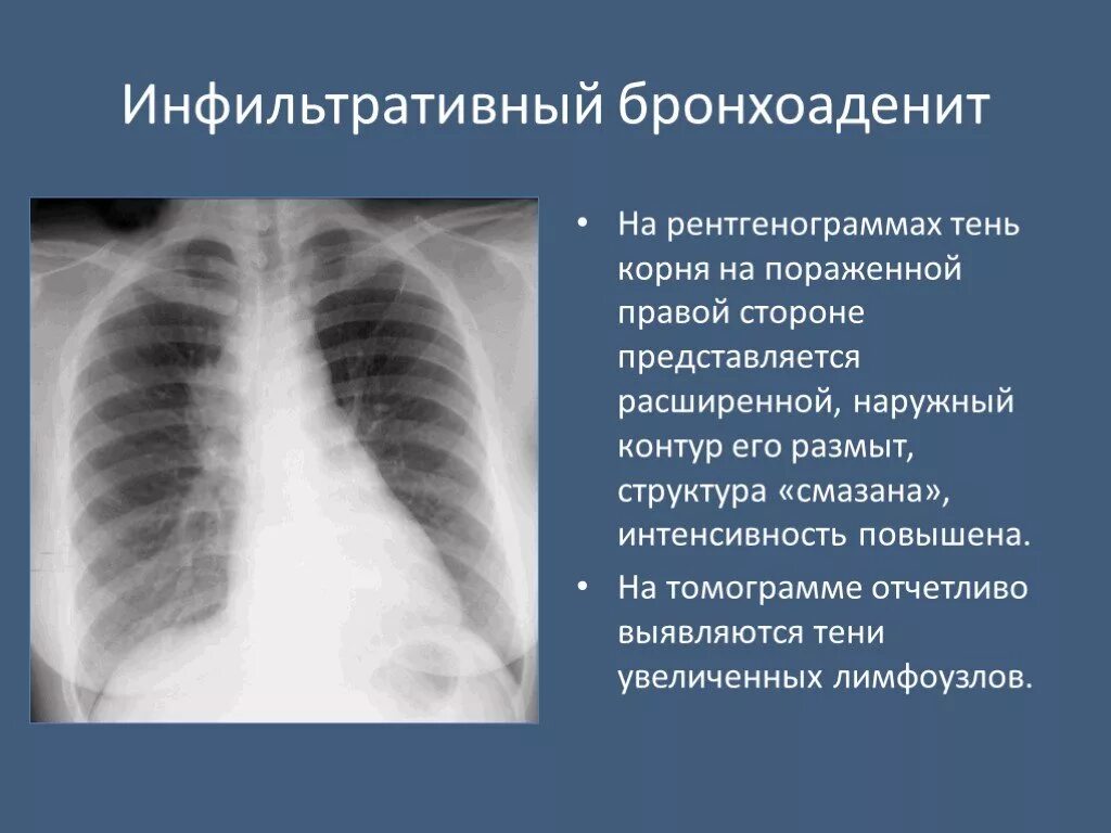 тень на легком на флюорографии что это