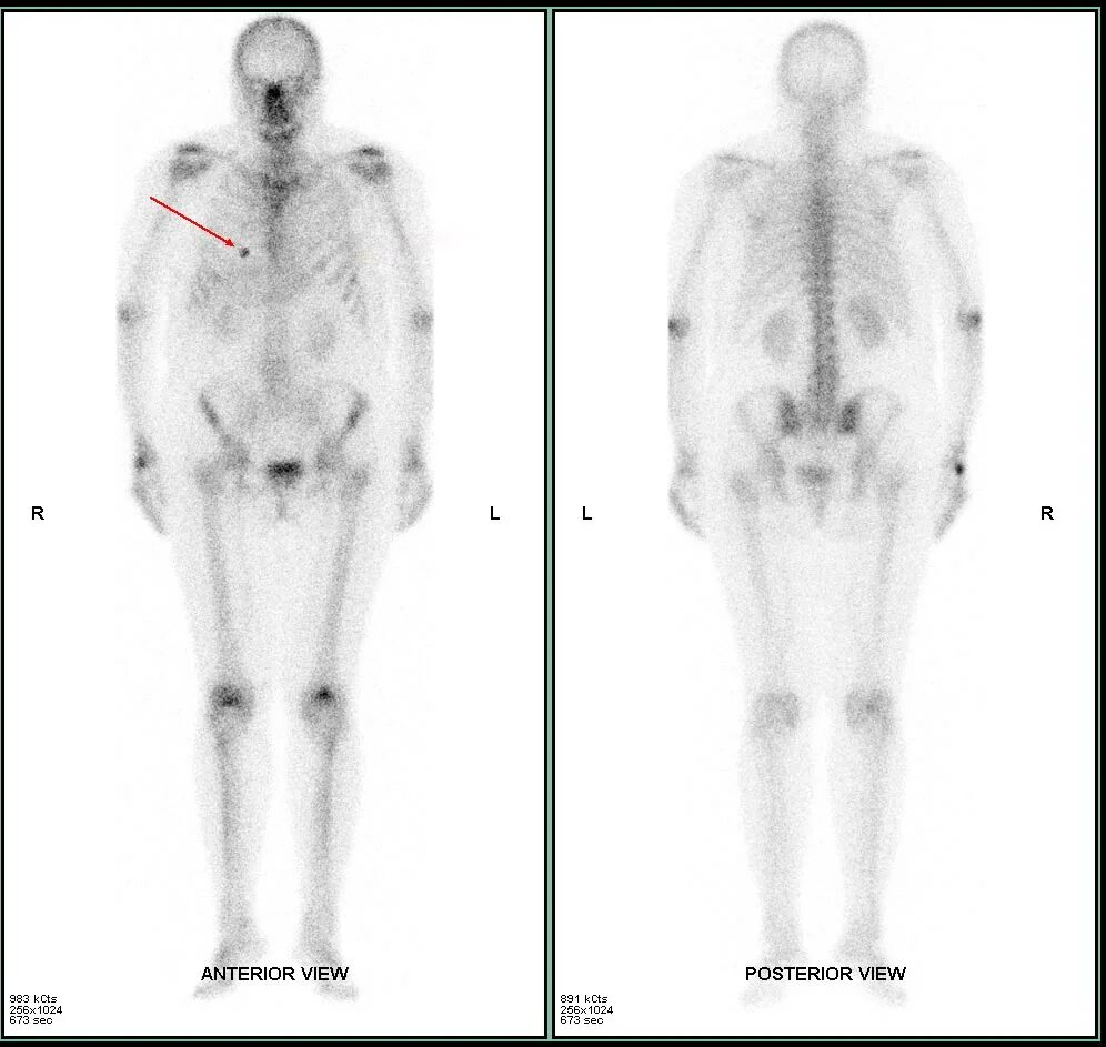 Метастатическое поражение кости. Сцинтиграфия метастазы очаг. Сцинтиграфия костей метастазы. Сцинтиграфия костей метастазы РМЖ. Сцинтиграфия метастазы в кости.