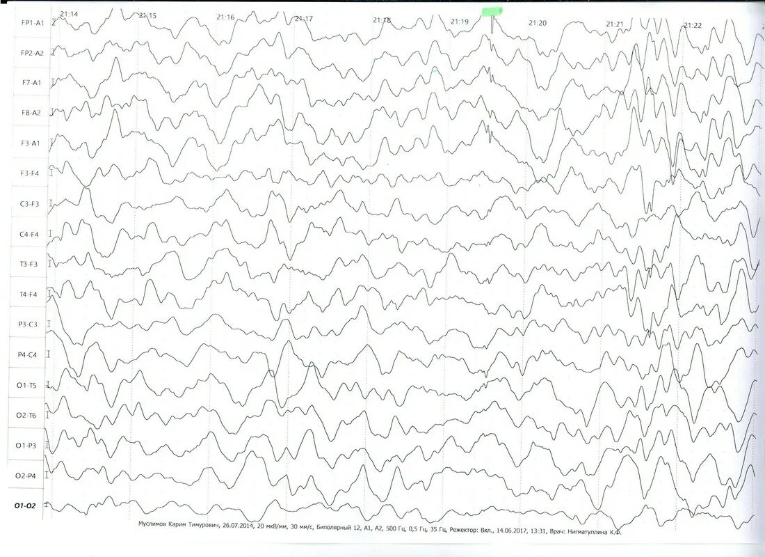 Ээг детям нижний новгород. ЭЭГ аутиста. Фаст Активити на ЭЭГ. Brushes -эффект на ЭЭГ У детей. Excessive fast activity на ЭЭГ.