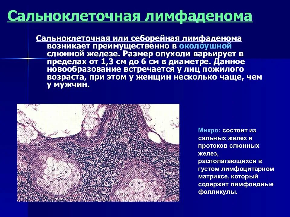 Опухоли слюнной железы гистология. Опухоль околоушной слюнной железы. Новообразования околоушной железы. Опухоли слюнных желез классификация. Доброкачественная железистая опухоль