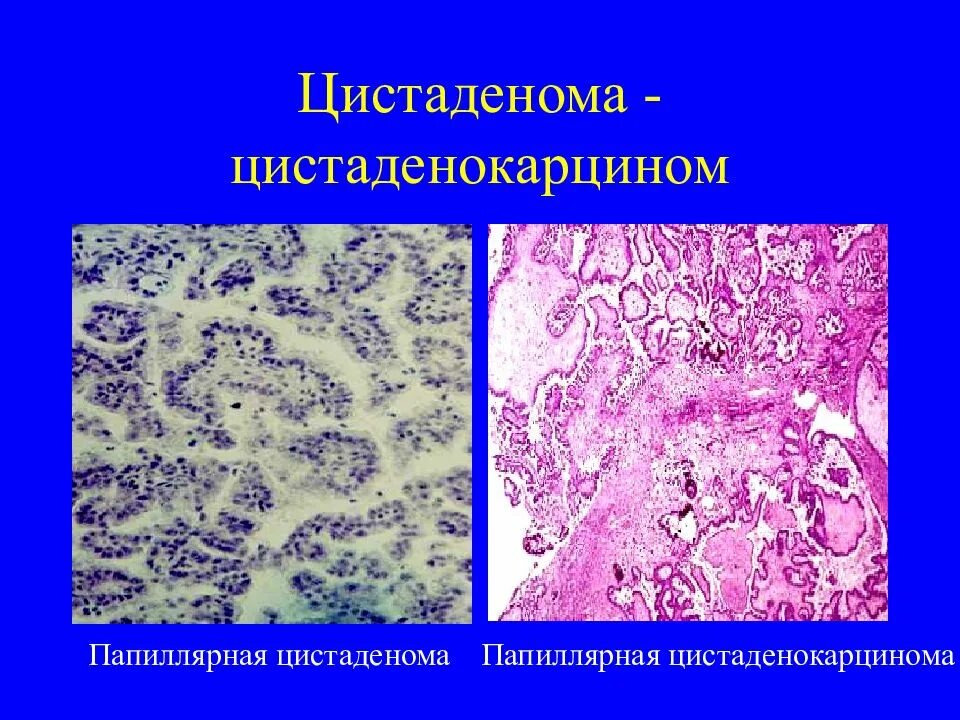 Гистология цистаденомы. Серозная цистаденокарцинома яичника гистология. серозная цистокарцинома гистология. серозная папиллярная цистаденома яичника гистология. серозная папиллярная цистаденома микропрепарат.