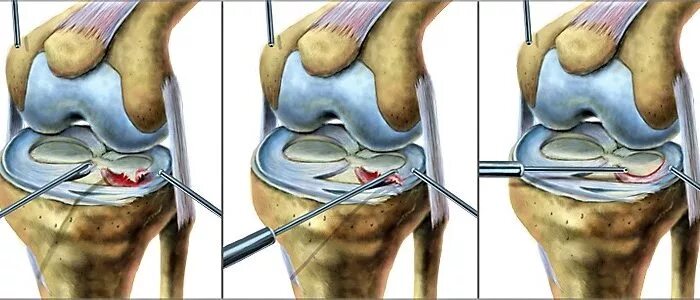 Артроскопическая резекция мениска. Мениск коленного сустава. Медальный мениска коленного сустава. Разрыв медиального мениска по Stoller 3.