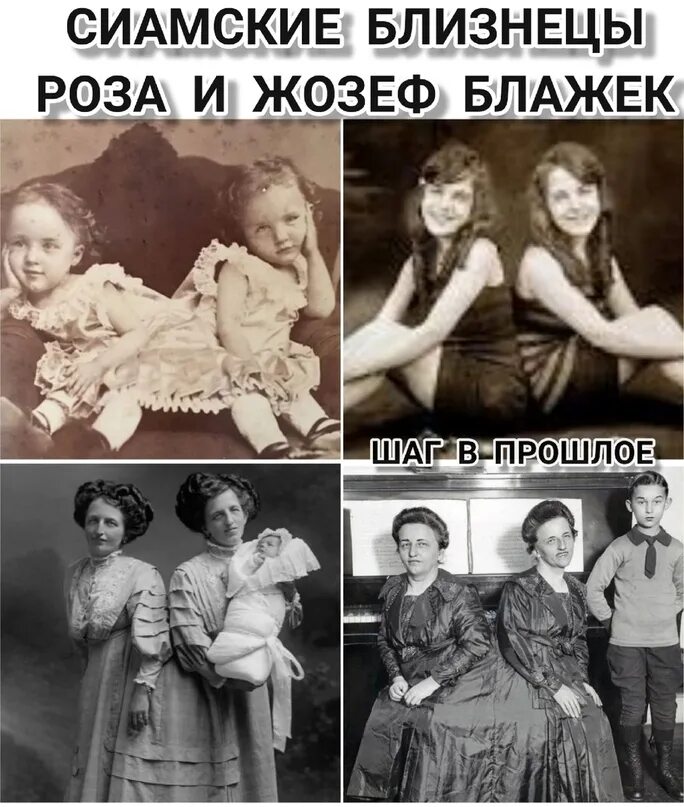 Сиамские близнецы которые вышли замуж. Сиамских близнецов розы и жозефы блажек. миртл корбин сиамские близнецы. сестры блажек.