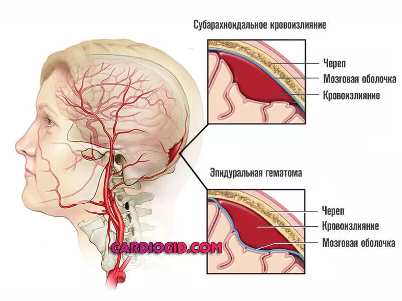 Субарахноидальное внутрижелудочковое кровоизлияние. Субарахноидальное кровоизлияние головного мозга ликвор. Субарахноидальное кровоизлияние головного мозга пространство. Базальное кровоизлияние субарах.