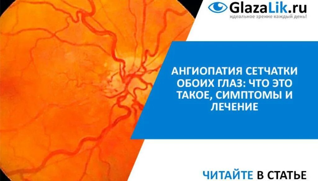 Ангиопатия сетчатки обоих. Нейроангиопатия сетчатки обоих глаз. Ангиопатия сосудов сетчатки обоих глаз. Ангиопатия сетчатки 35.0.