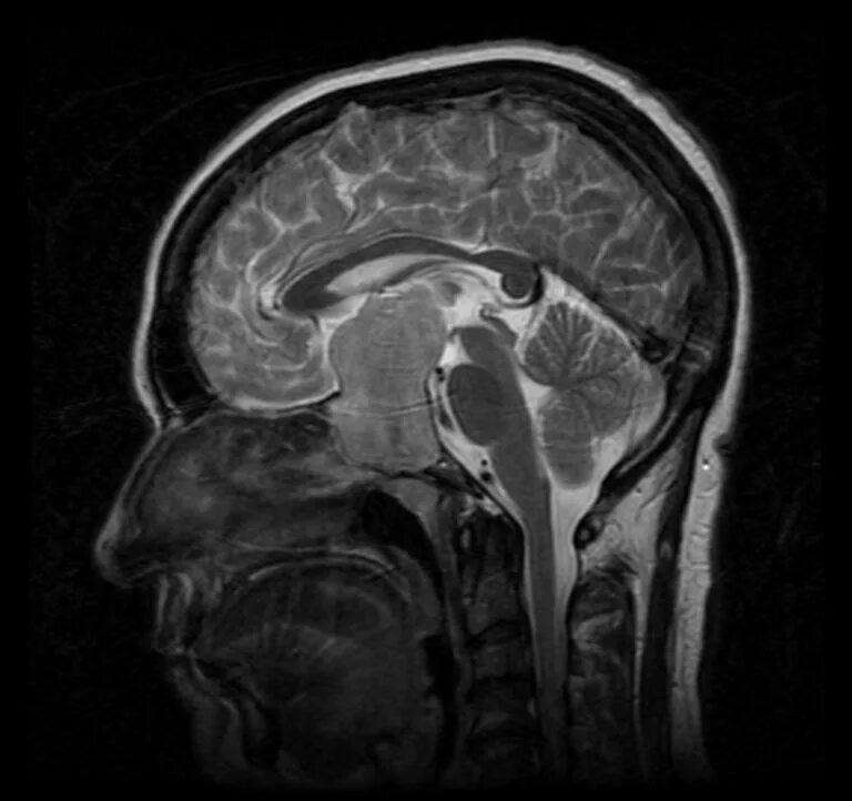 Ликвородинамика головного мозга мрт. Мрт ГМ С ликвородинамикой. Кт картина ликвородинамики головного мозга. Нарушение ликвородинамики на мрт головного. Мрт головы тамбов