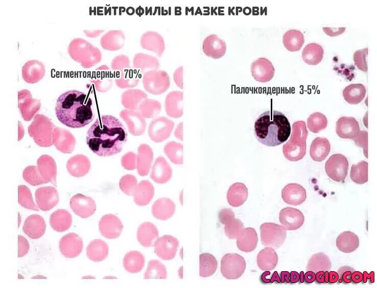 Понижены сегментоядерные нейтрофилы в крови у женщин. Сегментоядерные нейтрофилы в мазке крови. Гранулы сегментоядерных нейтрофилов. Палочкоядерные и сегментоядерные нейтрофилы. Палочкоядерный нейтрофил.