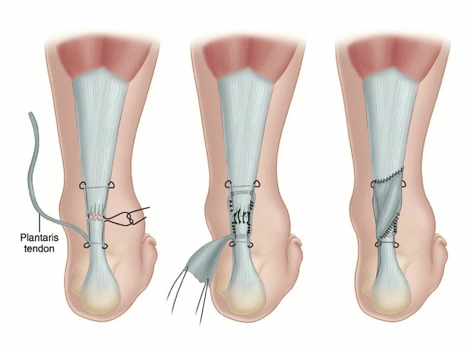 Разрыв ахиллова сухожилия операция. Ахиллово сухожилие растяжение. Операция на ахиллово сухожилие. Ахиллово сухожилие разрыв ахиллова сухожилия