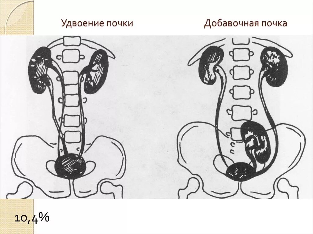 Удвоение лоханки почки кт. Удвоение почки у ребенка. Удвоение почки что это такое у взрослых. Врожденные аномалии развития чашечно лоханочной системы почки. Неполное удвоение члс.