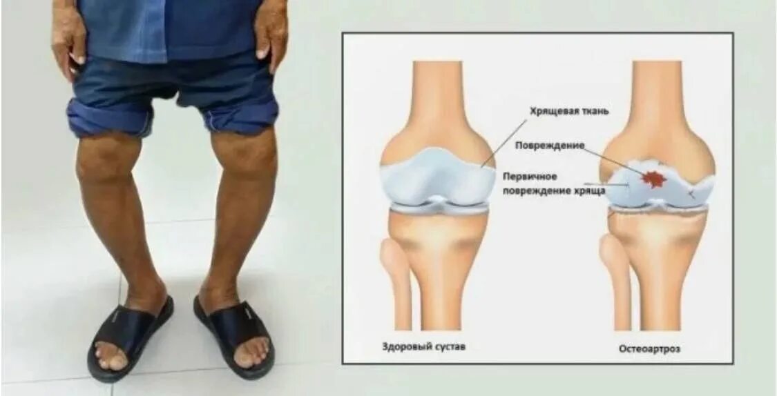 Гонартроз остеоартроз. Деформирующий гонартроз коленного сустава 2-3 степени. Деформирующий гонартроз коленного сустава. Деформирующий остеоартрит коленного сустава. Артроз коленного сустава название