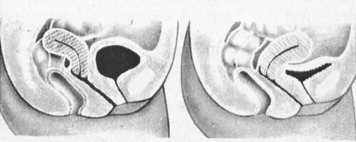 Изгиб шейки. Матка кзади и кпереди. Шейка кзади. Загиб матки кзади. Шейка матки загиб кзади.