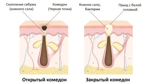 Закупорка волосяных