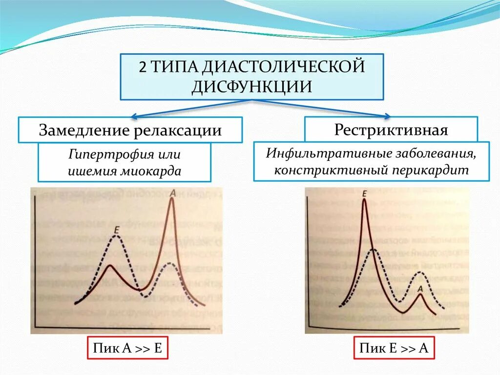 Типы диастолической дисфункции. Типы нарушения диастолической функции лж. Диастолическая дисфункция на ЭХОКГ. Диастолическая дисфункция по рестриктивному типу.