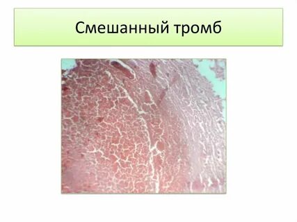 Микропрепарат смешанный тромб в сосуде
