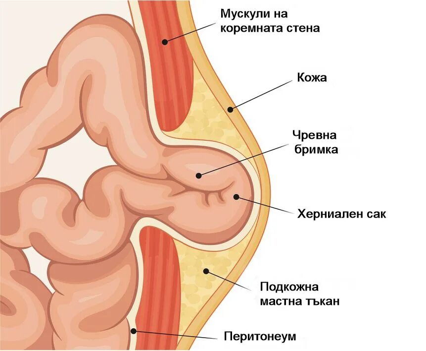 Брюшная грыжа симптомы и лечение