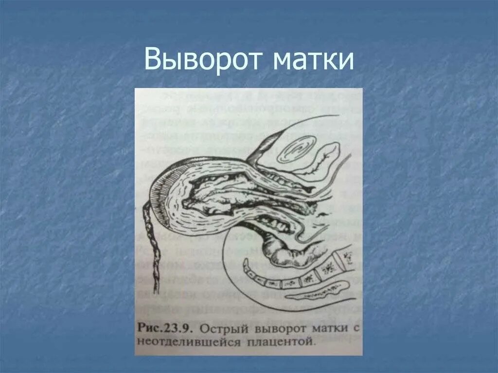 Почему опускается матка. Послеродовый выворот матки. Вправление выворота матки.