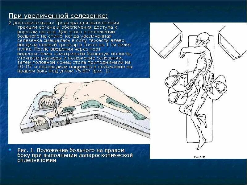 Спленэктомия что это. Положение пациента при спленэктомии. При повреждении селезенки характерно положения больного. Для разрыва селезенки характерно положение больного. Для повреждения (разрыва) селезенки характерно положение больного:.