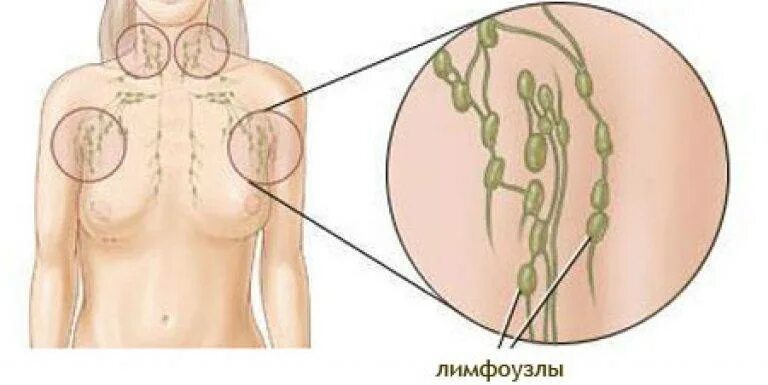 Лимфоузлы под мышками расположение у женщин. Лимфатические узлы молочных желез. Лимфатическая система подмышечной впадины. Лимфаденит подмышечных узлов. Подмышечные лимфоузлы схема расположение.