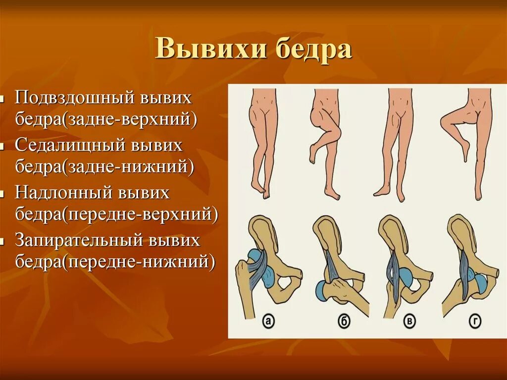 Вывих тазобедренного сустава симптомы. Характерные симптомы травматического вывиха бедра. вывихи тазобедренного сустава классификация. подвывих головки бедренной кости классификация. подвывих тазобедренного сустава классификация.