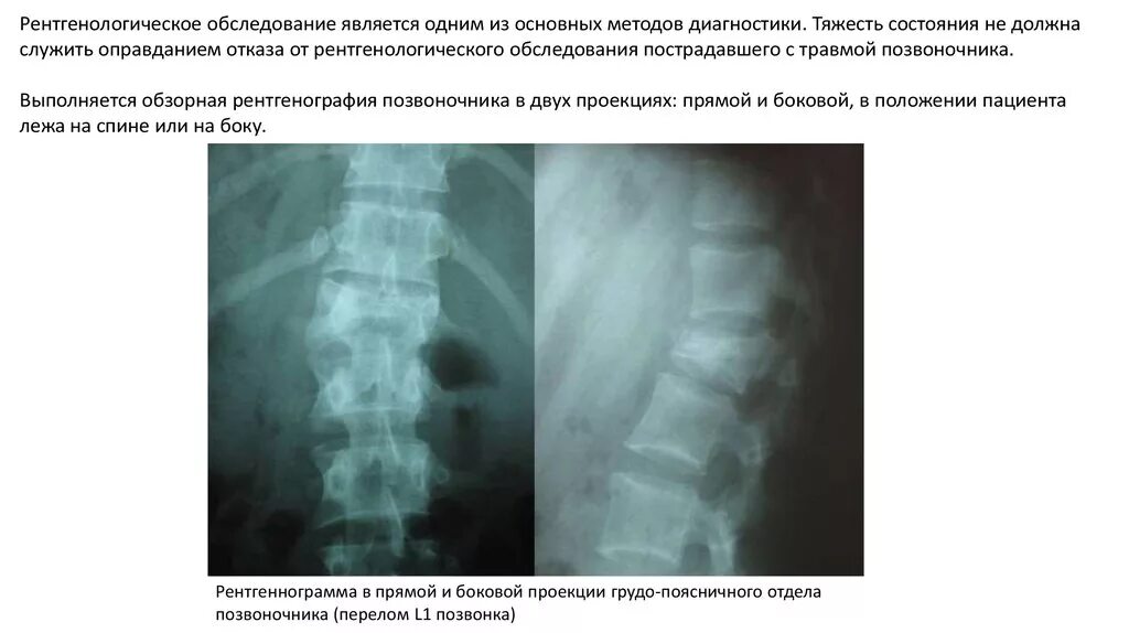 Грудной отдел позвоночника рентген норма. Рентгенограммы грудного отдела позвоночника норма. Рентген поясничного отдела с функциональными пробами. Остеохондроз поясничного отдела позвоночника рентген. Рентгенография позвоночника в 2 х проекциях