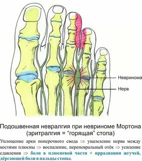 Почему немеет большой палец на ноге правой