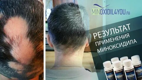Как правильно пользоваться миноксидилом
