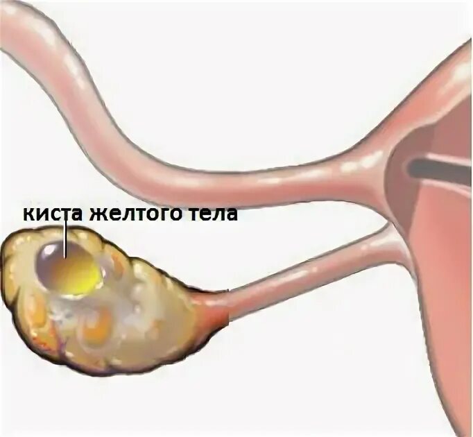 Киста яичника orads. Регресс кисты желтого тела. Киста желтого тела яичника апоплексия. Киста желтого тела 51 34 40. Киста желтого тела макропрепарат.