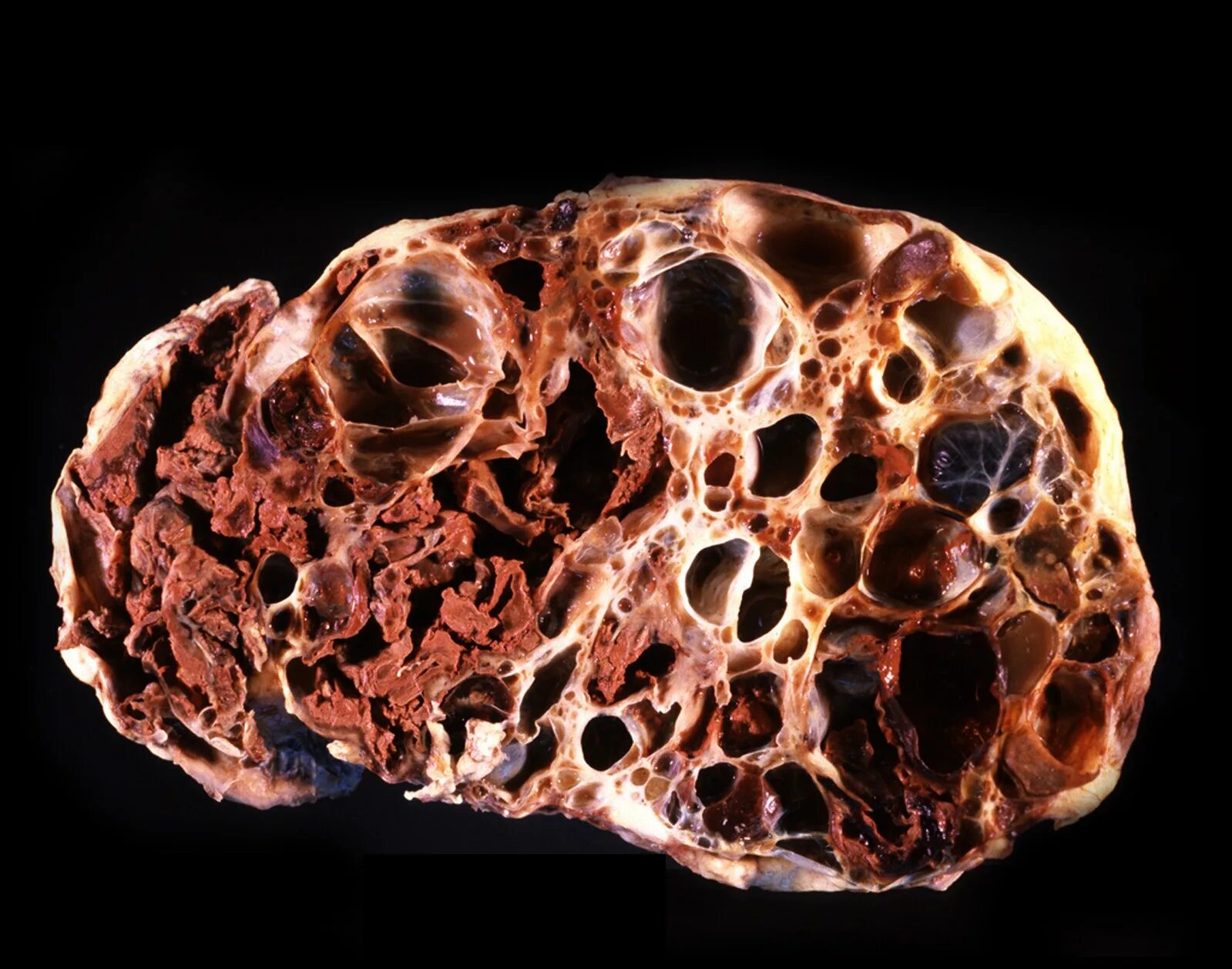 поликистоз почек симптомы лечение