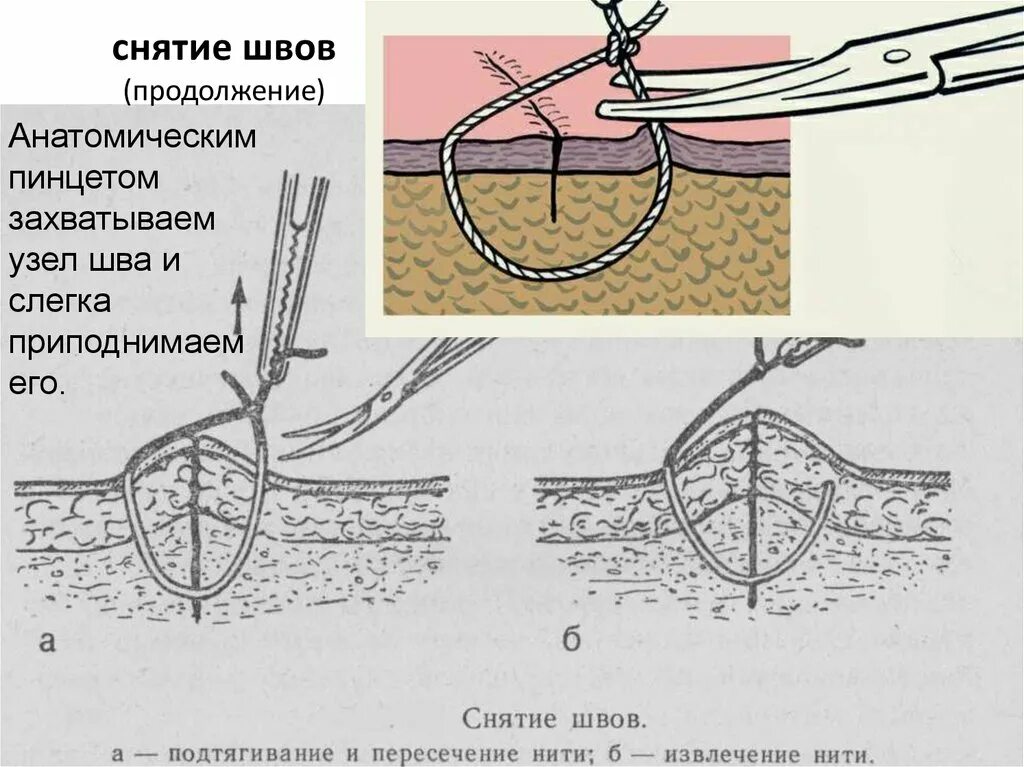 Как снять швы самостоятельно. Чем можно обрабатывать швы после операции