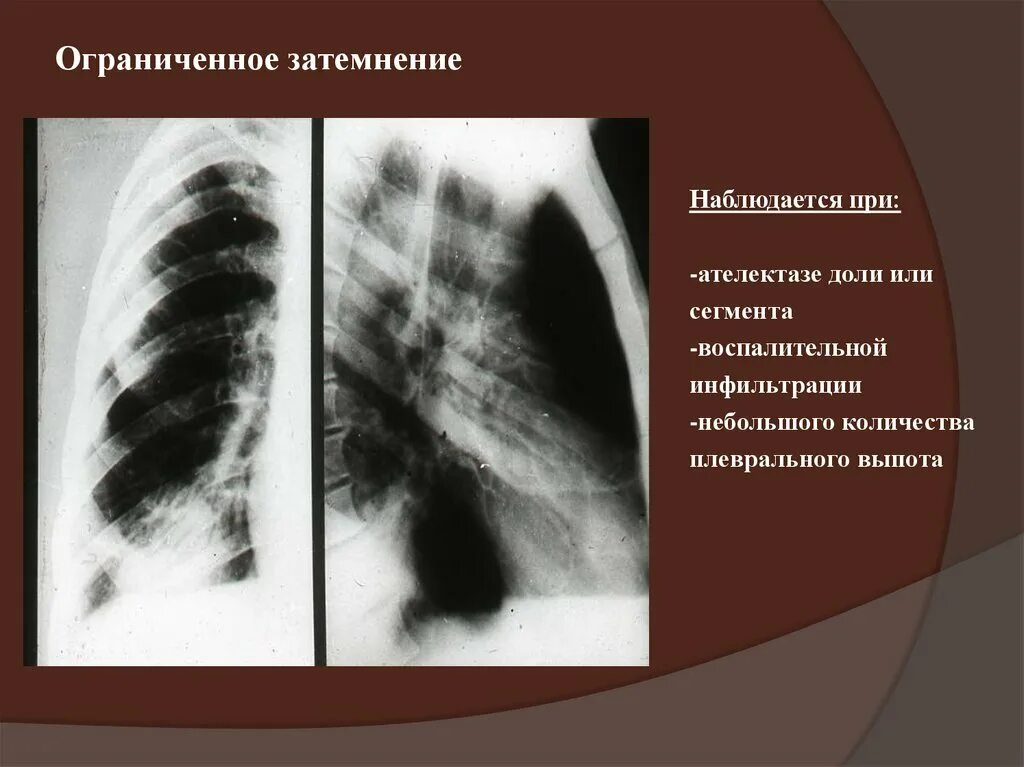 Ограниченное затемнение легких рентген. Ограниченное затемнение легкого. Затемнение доли легкого. Затемнение легочного поля при.