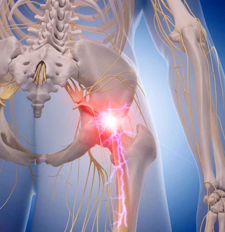 Защемление в пояснице симптомы. Седалищный нерв. Защемление седалищного нерва. Заще ление седалищного нерва. Ишиас - защемление седалищного нерва.