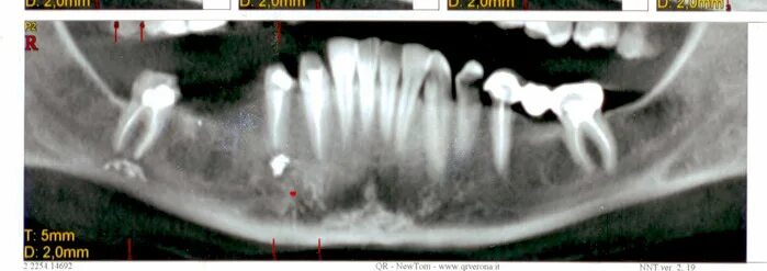 Рассосался корень зуба. Выведение пломбировочного материала за Апекс. Пломбировочный материал в нижнечелюстном канале. Выведение пломбировочного материала за верхушку зуба. Попадание пломбировочного материала в нижнечелюстной канал.