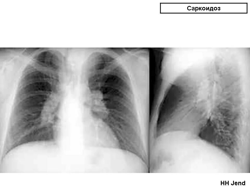 Лимфаденопатия внутригрудных лимфоузлов что это такое. Саркоидоз рентген грудной клетки. Лимфаденопатия средостения рентген. Рентген лимфоузлов средостения. Увеличенные лимфоузлы в легких.